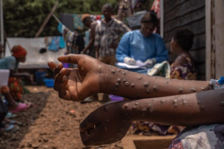 Imagem de capa da not&iacute;ciaAngola regista 19 novos casos de Mpox e quatro altas m&eacute;dicas